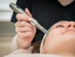 Microneedling behandeling met dermapen