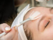 Chemische peeling behandeling
