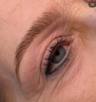 Brow lift
