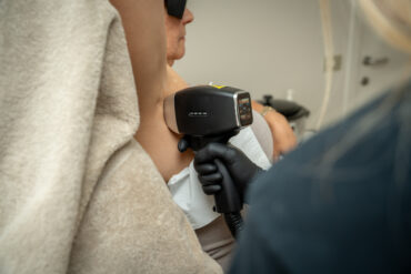 Wat is een chemische peeling en hoe werkt het?