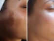 Peeling tegen pigmentvlekken