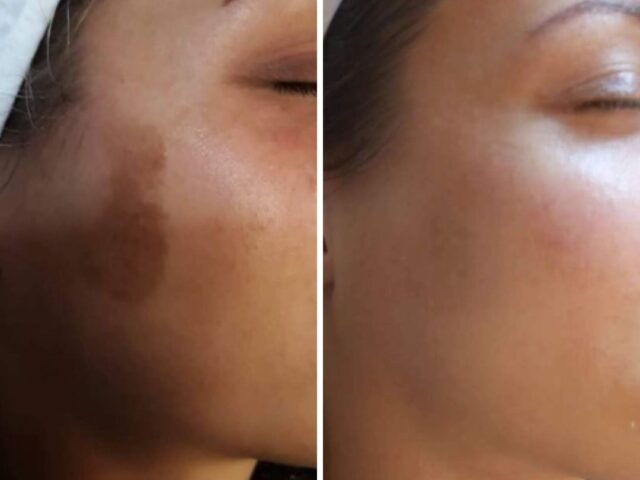 Peeling tegen pigmentvlekken