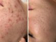 Peeling tegen acne