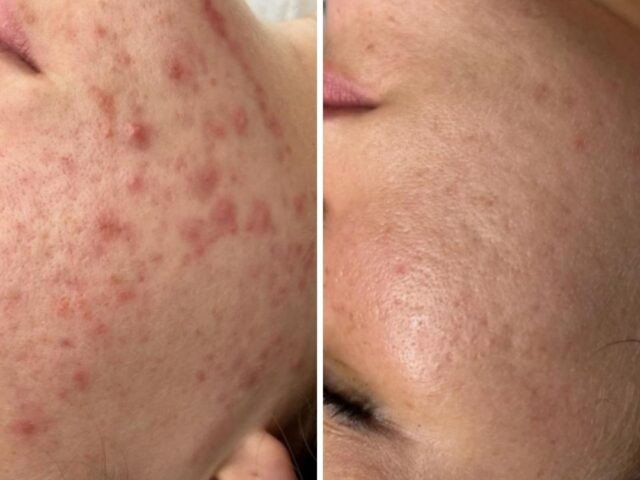 Peeling tegen acne