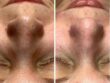 Huid na chemische peeling