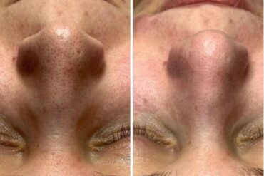 Waarom Wij Niet Geloven in One-Size-Fits-All Skincare