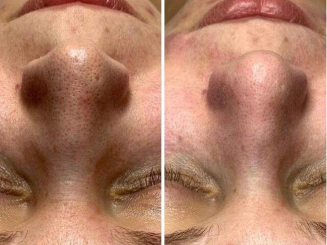Huid na chemische peeling