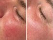 Peeling aangebracht op de wangen