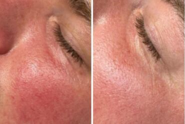 Laserontharing voor Mannen: Effectief en Comfortabel
