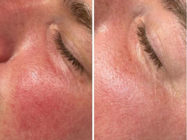Peeling aangebracht op de wangen