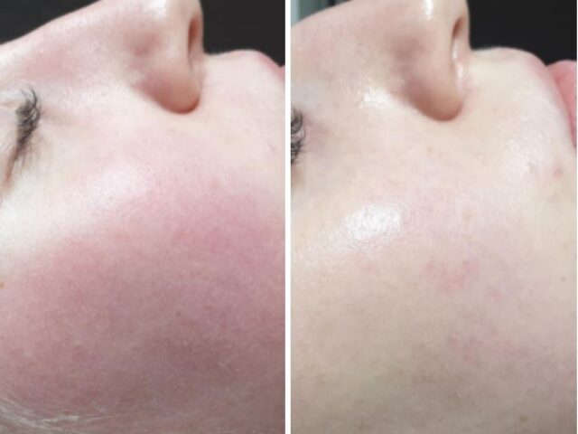Vrouw met glanzende huid na peeling